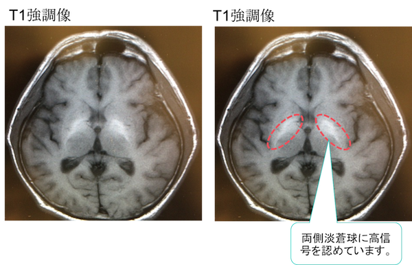 肝性脳症・肝硬変の頭部MRIの画像診断は？T1WIで高信号？